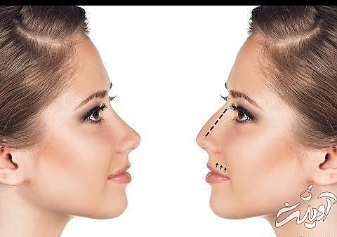 کوچک کردن بینی با راه کاملا طبیعی بینی زیبا بدون جراحی